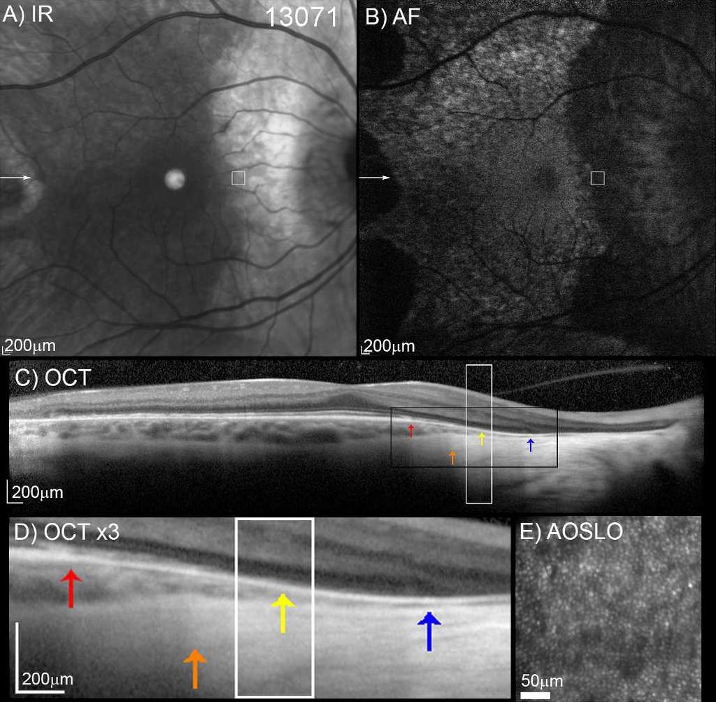 Adaptive Optics Imaging in Choroideremia IOVS j October 2014 j Vol. 55 j No. 10 j 6390 FIGURE 8. The IR (A), AF (B), and OCT (C) images from patient 13071, right eye.
