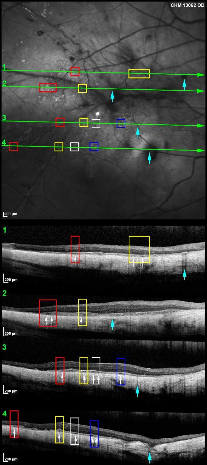 Adaptive Optics Imaging in Choroideremia IOVS j October 2014 j Vol. 55 j No. 10 j 6392 choroideremia.