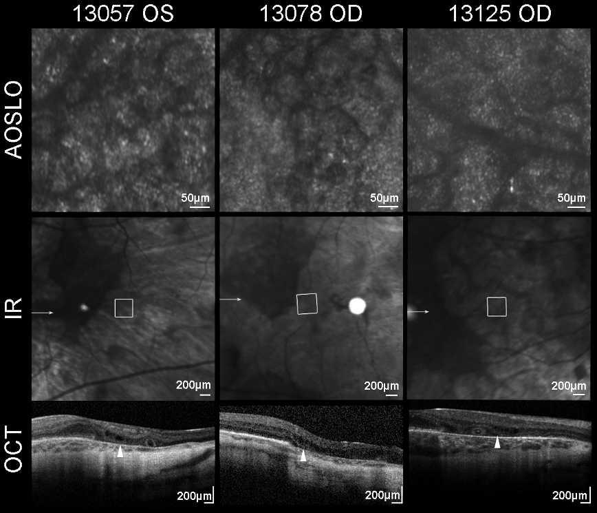 Adaptive Optics Imaging in Choroideremia IOVS j October 2014 j Vol. 55 j No. 10 j 6393 FIGURE 12.