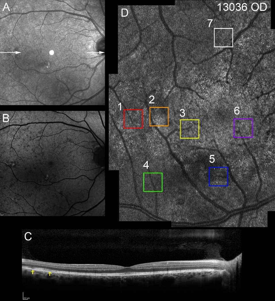 Adaptive Optics Imaging in Choroideremia IOVS j October 2014 j Vol. 55 j No. 10 j 6394 FIGURE 13. The IR, OCT, AF, and AOSLO montage images of the right eye of choroideremia carrier 13036.