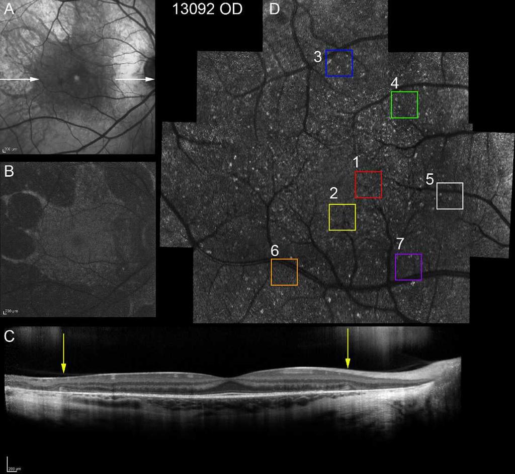 Adaptive Optics Imaging in Choroideremia IOVS j October 2014 j Vol. 55 j No. 10 j 6384 FIGURE 1. Retinal images from the right eye of choroideremia patient 13092.