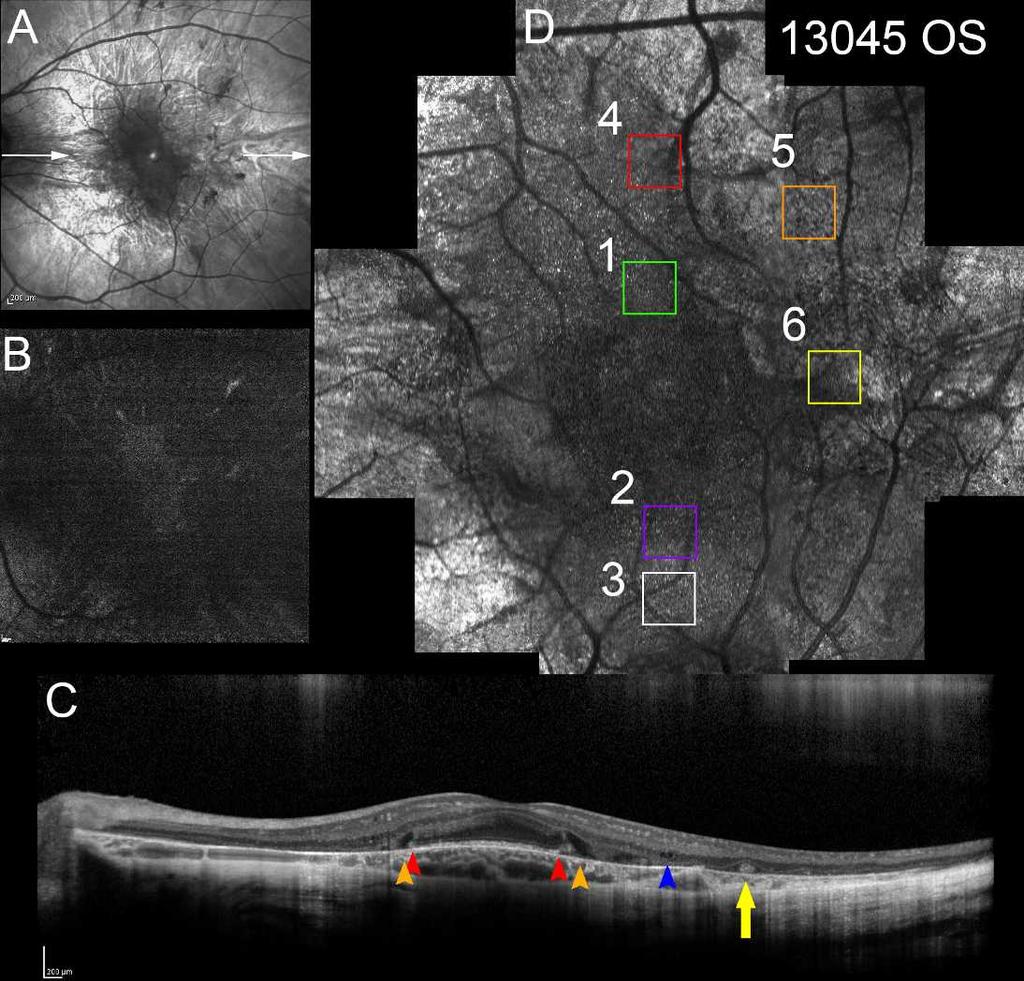 Adaptive Optics Imaging in Choroideremia IOVS j October 2014 j Vol. 55 j No. 10 j 6385 FIGURE 3. Retinal images from the left eye of choroideremia patient 13045.