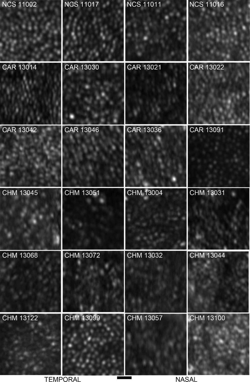 Adaptive Optics Imaging in Choroideremia IOVS j October 2014 j Vol. 55 j No. 10 j 6387 FIGURE 5.
