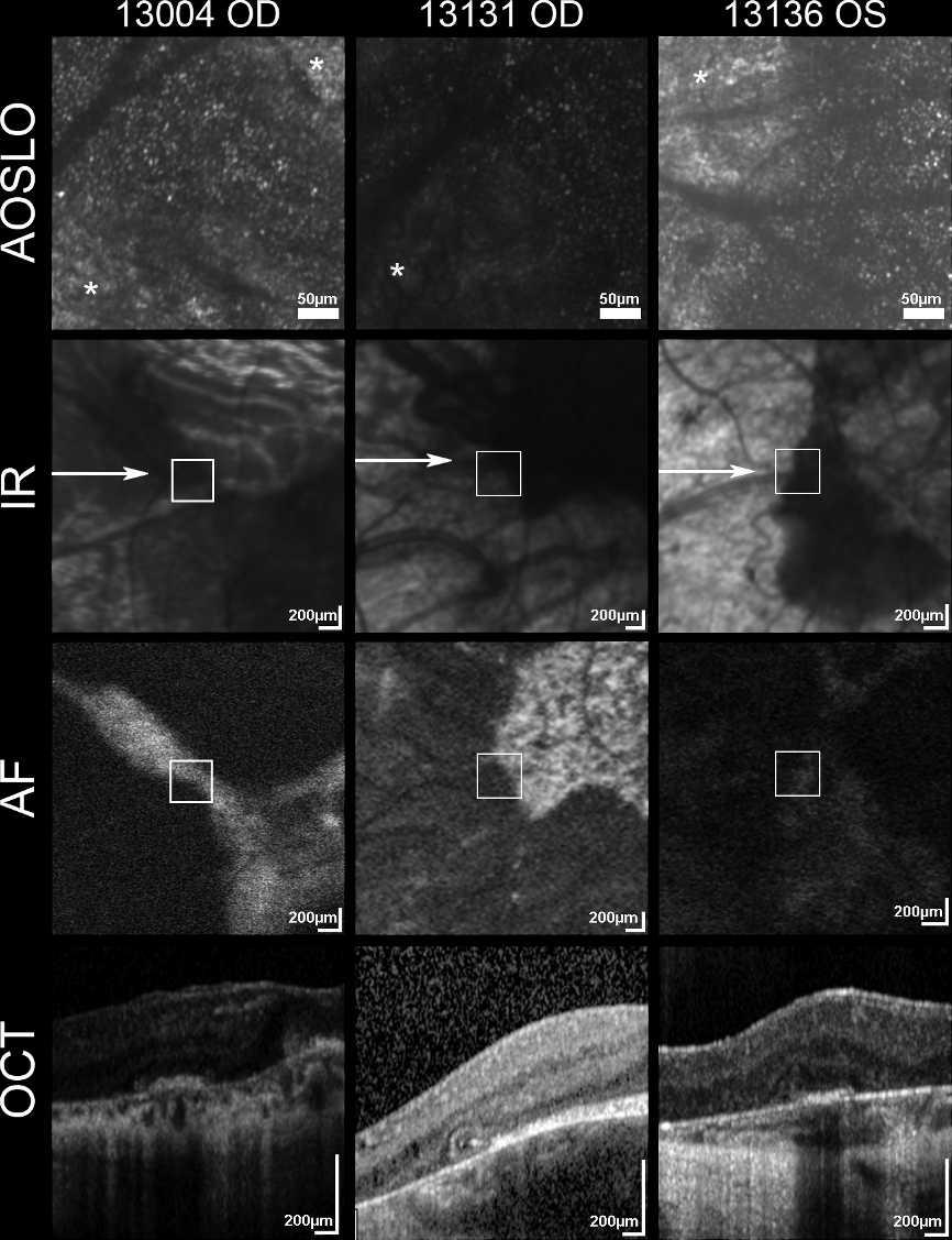 Adaptive Optics Imaging in Choroideremia IOVS j October 2014 j Vol. 55 j No. 10 j 6389 FIGURE 7.