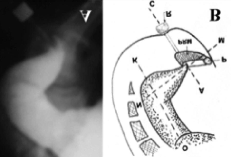 Pathophysiology and diagnosis of descending perineum syndrome in children Figure 1. lateral x-ray image of the anorectal zone of a healthy child (A) and a schematic representation (B).