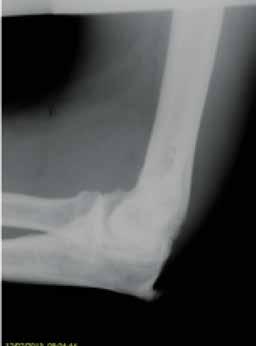 Loose Bodies Mild trauma or repetitive use can cause an inflammatory reaction to debris/synovium within the elbow resulting in calcified masses.