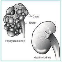 What are polycystic kidneys and livers?! Cystic degenerative condition! Multiple cystic (thin walled fluid filled cavity)!