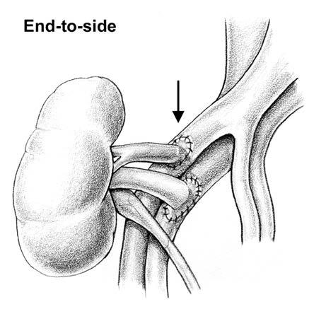 iliac vessels Ureter onto bladder