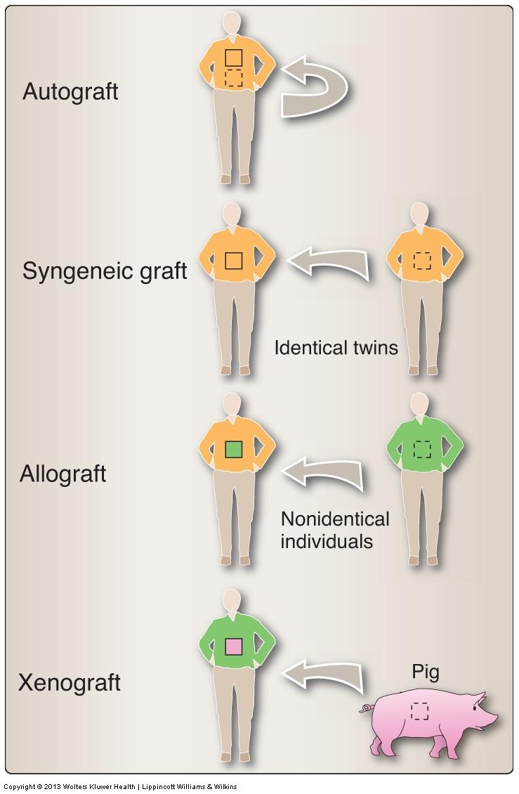 Different types of Transplants Autograft Self tissue transferred from one part of body to another Isograft (syngenic graft) Tissue transferred between genetically identical