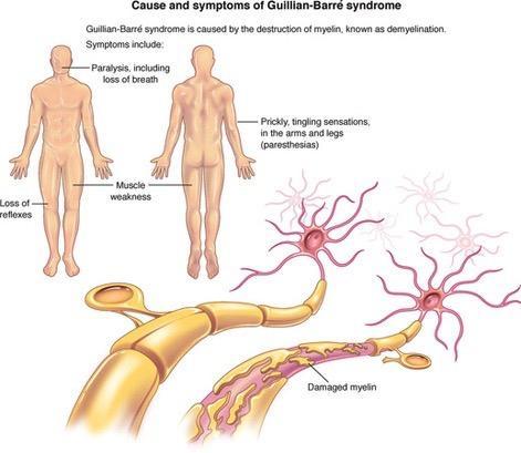 Guillain-Barré syndrome Temporary paralysis - often triggered by recent infection.