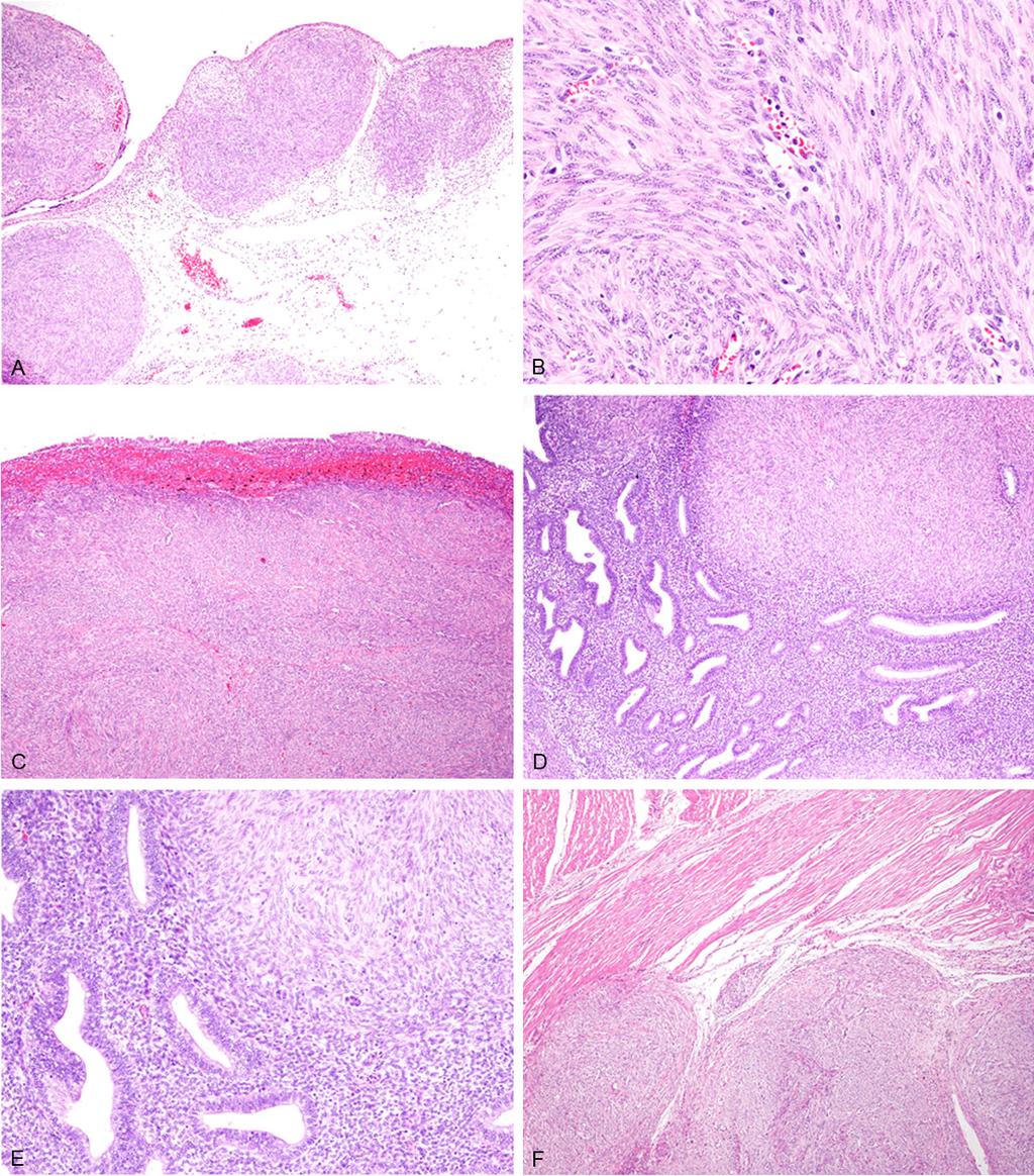 Figure 1. Histopathological features of the peritoneal nodules and cecum. A: Multiple nodules composed of spindle cells are present in the peritoneal surface, HE, x 40.