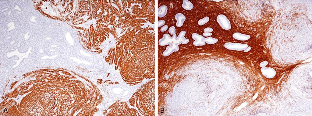 Figure 2. Immunohistochemical features of the peritoneal nodules. A: Desmin is expressed in the spindle cells, x 40. B: CD10 is expressed in the endometrial stroma, x 40.