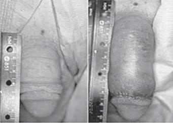 Phalloplasty Phenotype Pseudo hermaphrodite Pubic hair Pubic lipectomy pre-operation post-operation Surgical procedure to lengthen, thicken, reconstruct or otherwise reshape the penis.