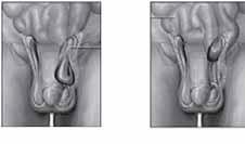 direct inguinal hernia indirect inguinal hernia it. In AIS, an inguinal hernia is the protrusion of the testes through the inguinal canal.