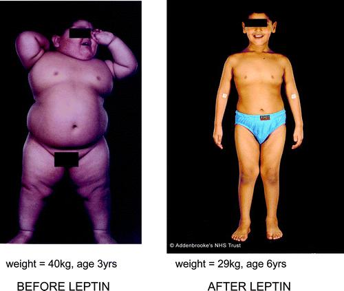 reported in humans 2002: Recombinant human leptin treats leptin deficiency Zhang et