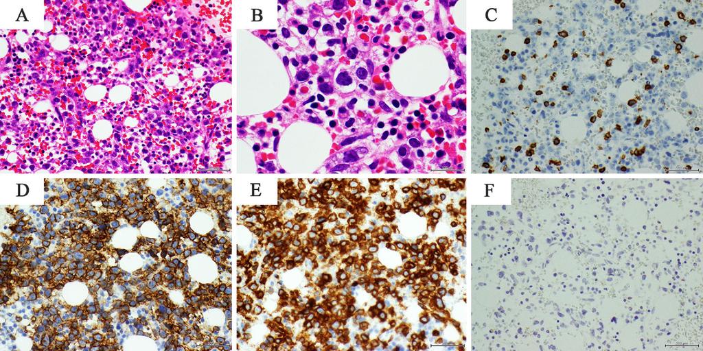 Figure 1. Histological and immunohistochemical findings of the bone marrow. Large-sized lymphoid cells with polymorphic conspicuous nuclear bodies were increased.