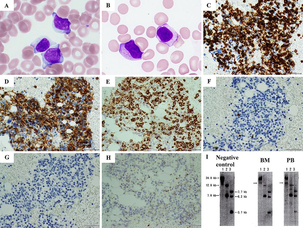 Figure 2. Clinical course. T cell large granular lymphocyte (T-LGL) lymphocytosis occurred Day 14 after withdrawal of MTX.