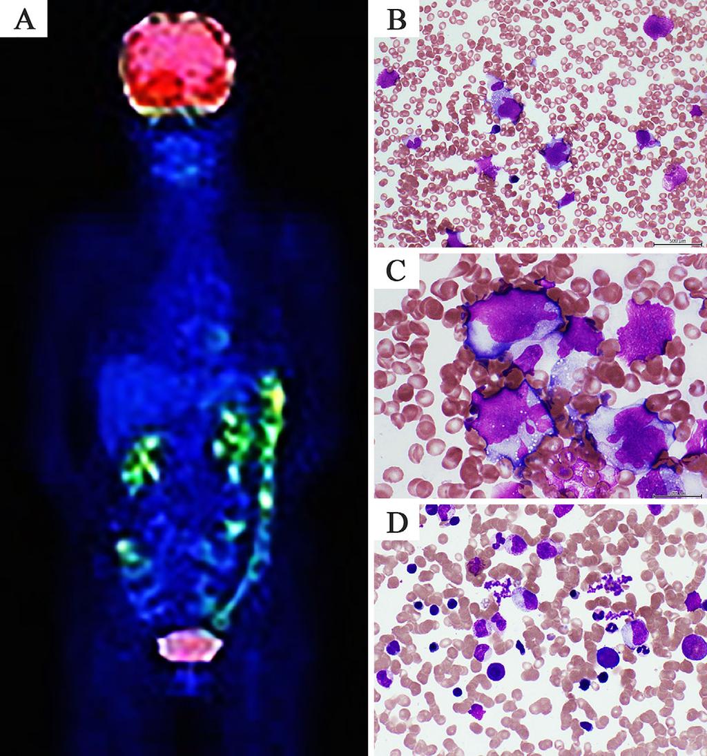 Figure 4. PET-CT and histology after regression of MTX-LPDs (A) Positron emission tomography/ computed tomography (PET/CT) imaging.