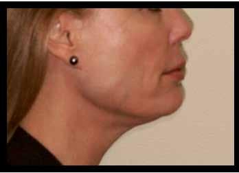 CLINICAL Figure 2. Before and after: masseter muscle gularis oris muscle, or the depressor labii, causing an elevation to the lower lip on the affected side.