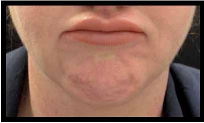 When those structures move, a residual wrinkling of the neck skin in an oblique direction occurs, contributing to the signs of ageing on the neck, lower face and jowls (Brandt and Bellman, 1998).