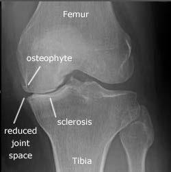 Typical presentations (Continued) Meniscal injury o Male or female o Twisting injury with physical activity.
