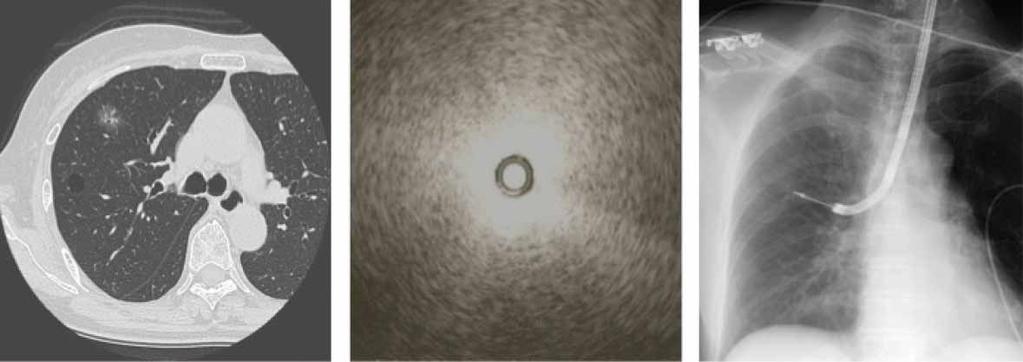 a) b) c) d) e) FIGURE 2 A representative case in a 74-year-old woman with pure ground-glass opacity (GGO) in the right upper lobe.