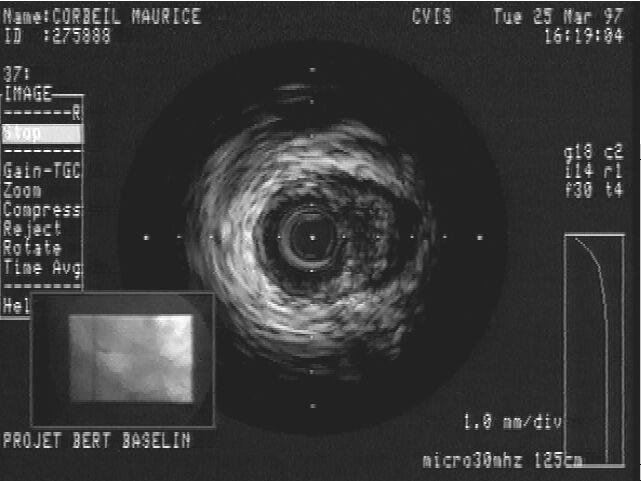 IVUS: Potentially unstable