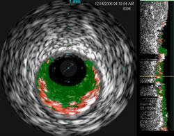 IVUS-RF Limitations: Unable to distinguish thrombi from other plaque components Limited spatial resolution
