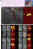 Detection by Near-Infrared Spectroscopy of Large Lipid Core Plaques at