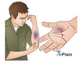 Hemophilia: X-linked recessive trait in humans Bleeders disease, the blood failed to clot properly when there is a wound.