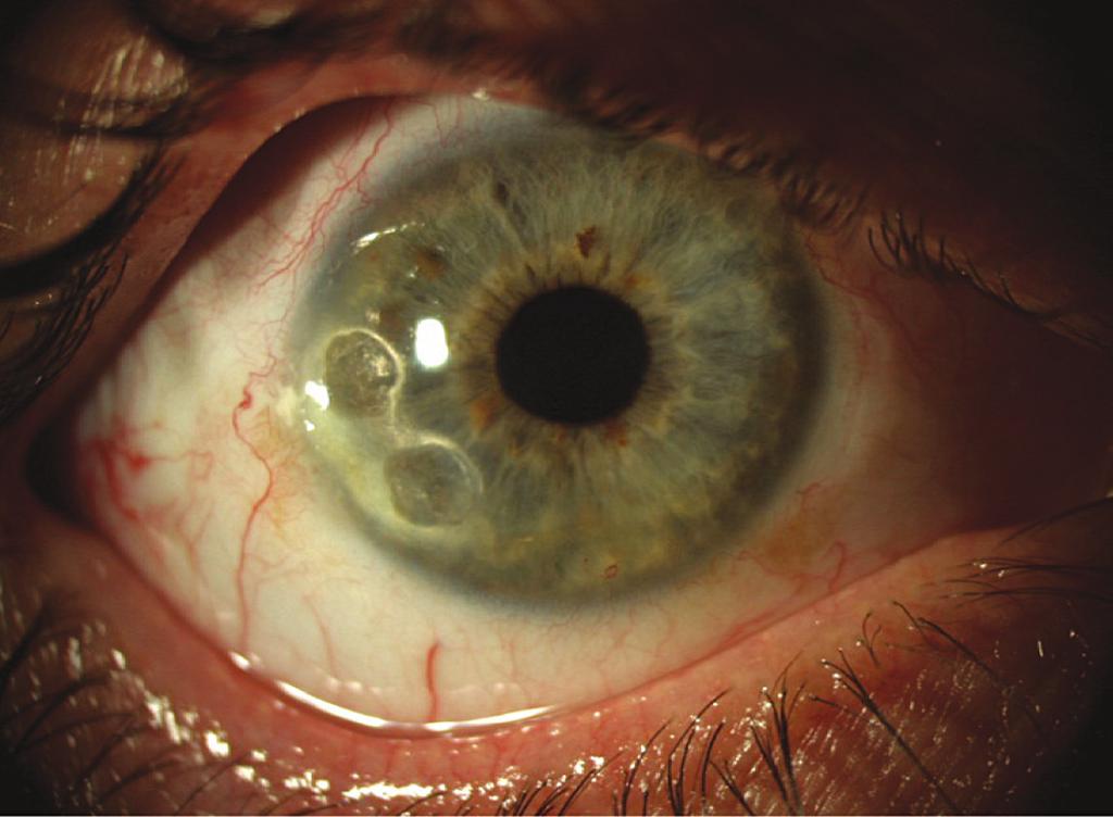 him (Figure 4B). Do you agree with this surgery in this case? What is your idea about living-related conjunctival-limbal allograft (lr-clal) surgery?