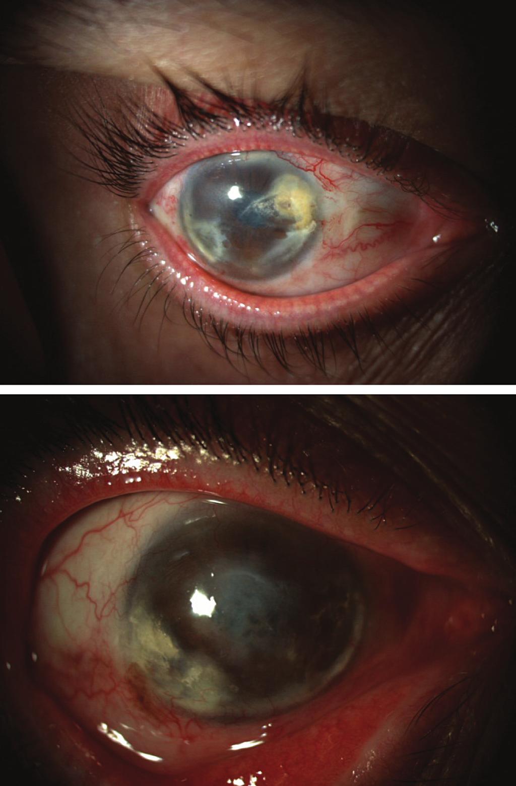 simultaneously addressing conjunctival, limbal, and corneal abnormalities.