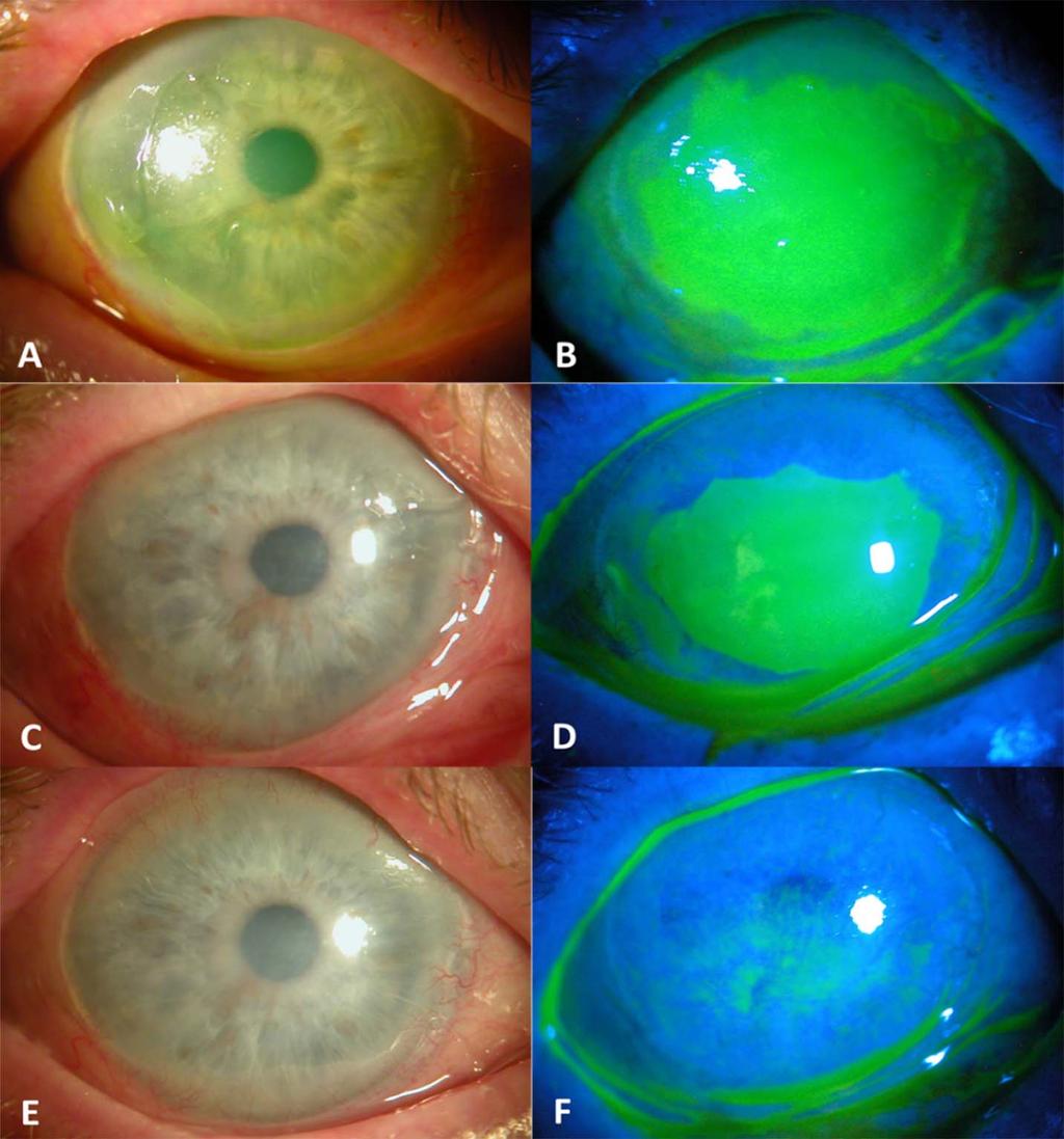 Figure 2. Clinical Course of Case #2. The OD (right eye) received corneal epithelial debridement to remove the entire loose epithelium due to EBMD (A, B).
