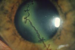 Herpes Simplex Keratoconjunctivitis HHV-1 infections may occur in the eye, producing severe keratoconjunctivitis.