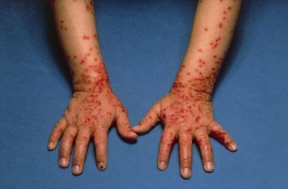 Herpetic Skin Infections o Usually manifest as