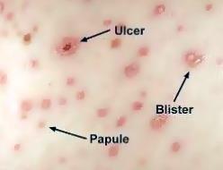 Varicella (Chickenpox) Subclinical varicella is unusual. The incubation period: 10 21 days.