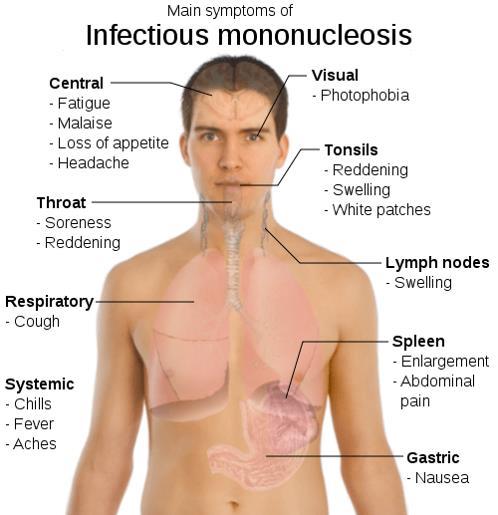 Infectious Mononucleosis (IM), Kissing Disease Infectious Mononucleosis (IM)