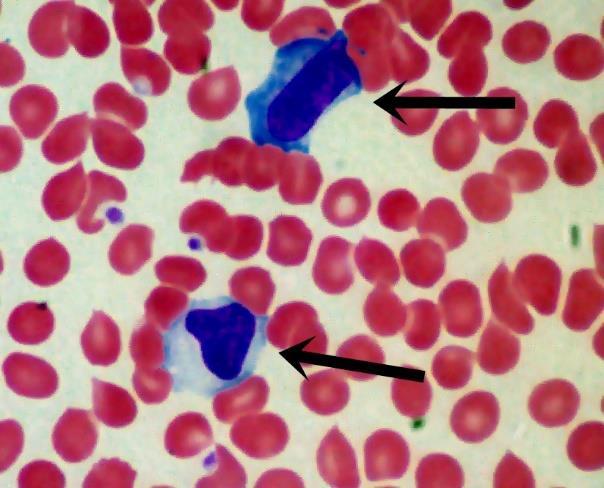 o The peripheral blood shows leukocytosis, an increase in T cells but not B