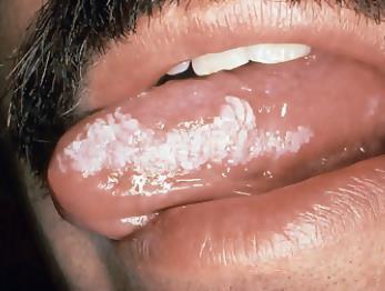Oral Hairy Leukoplakia caused by EBV AIDS