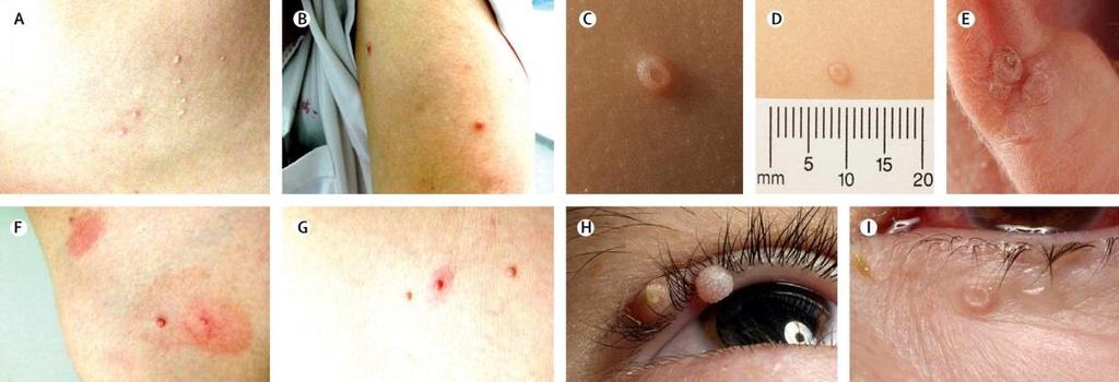 Molluscum contagiosum virus (MCV) Molluscum contagiosum is a viral infection characterised by small, discrete, skin-coloured, dome-shaped papules.
