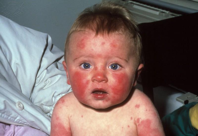 Clinical Disease (Erythema infectiosum, fifth disease) A childhood exanthema with characteristic rash ( slapped cheek appearance).