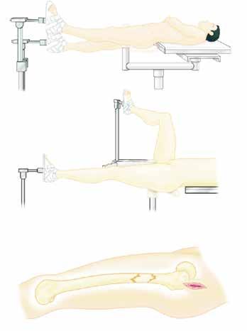 PREFACE The femoral nails are designed to accommodate a standard femoral locking mode or the reconstruction locking mode in the same leg.