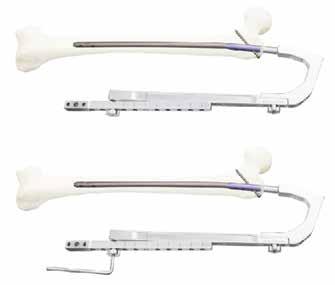 7. Stabilizing Distal Aiming Bar There may be some bending of the nail due to the pressure and weight of the soft tissue and the bone.