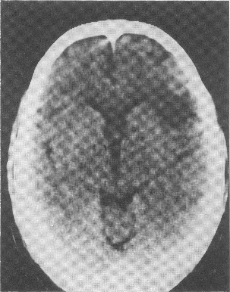 1038 M.C. GULLIFORD et al. Table I Radiological and electroencephalographic findings on admission Patient CT scan EEG 1 Right temporal lesion. Repetitive complexes right temporal region.