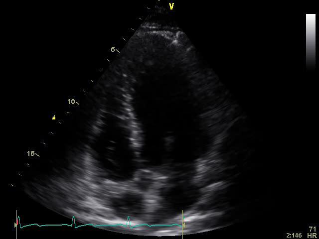 Outflow Tract Ventricular