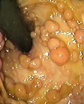 Case A: A 45 year old presents with rectal bleeding. Colonoscopy reveals numerous (approximately 40-50) polyps, most are <1 cm in size, a few are 1.5-2.0 cm. 1. What is the differential diagnosis? 2.