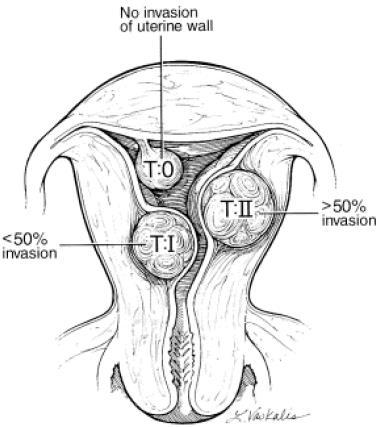 Fibroids - Classification How does this help with management?