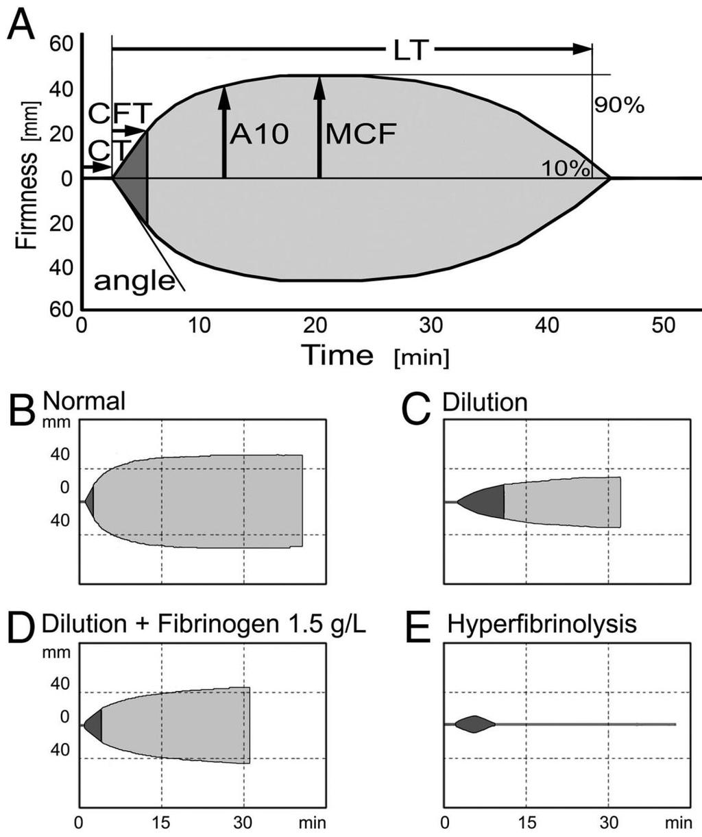 Thrombelastometry assesses kinetics of clot formation stability