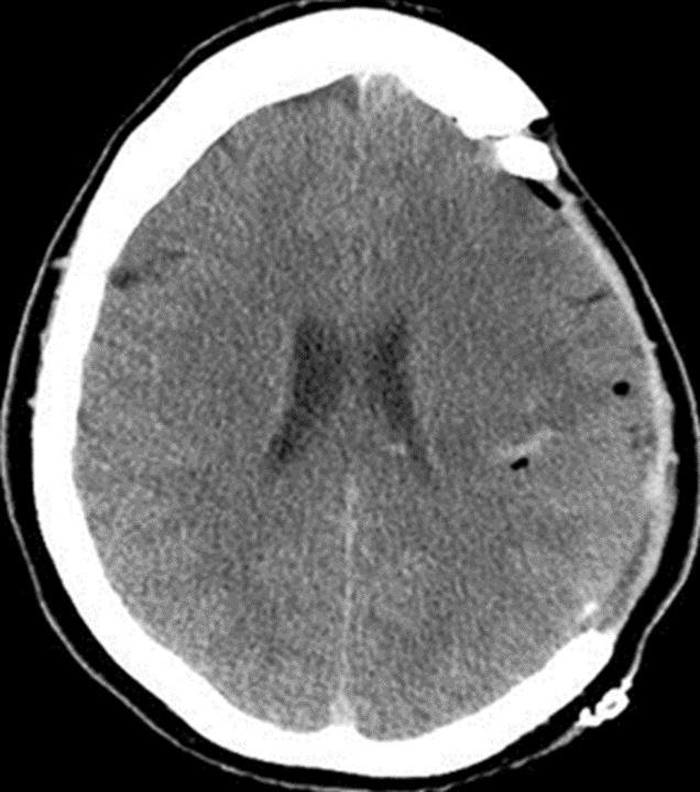 recommended Does improve survival and functional status for malignant stroke in patients