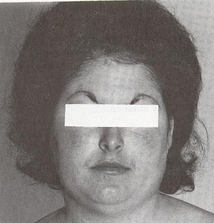 Clinical Features of Cushing s Syndrome Clinical